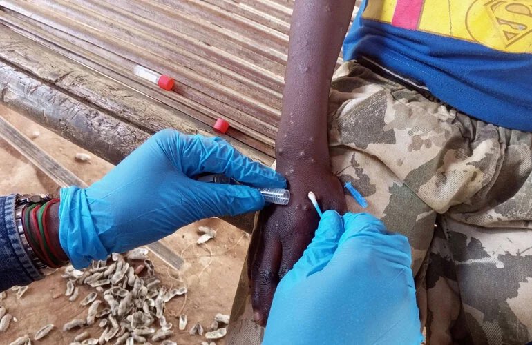 China refuerza controles fronterizos ante la propagación del mpox